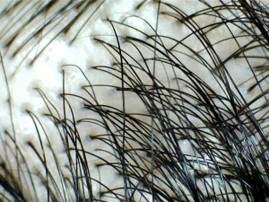 Top 10 myths about hair transplants