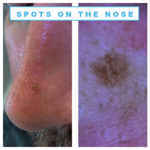 I have a spot or bump on the nose – what could it be?