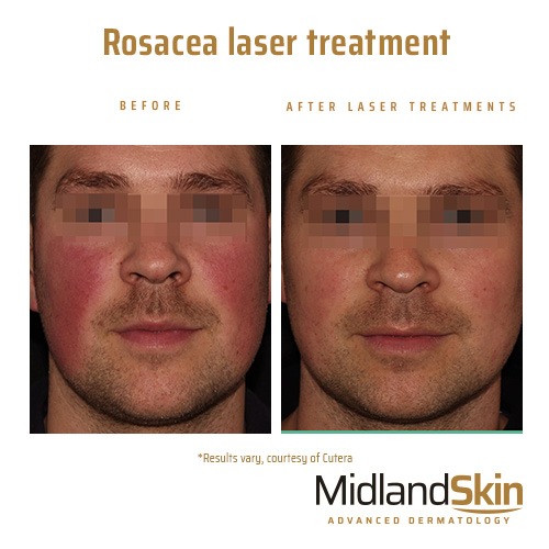 Why is my face red? Rosacea laser treatment