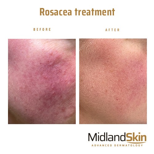 Rosacea treatment Midland Skin Birmingham