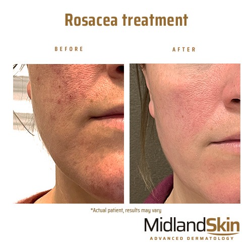 Rosacea treatment in Birmingham by Dermatologists