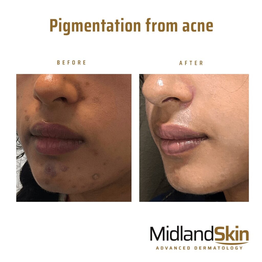 Treatment for acne hyperpigmentation