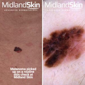 Suspicious Mole? Private vs NHS: What Happens and How Fast